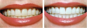 toothwhiteningbeforeafter